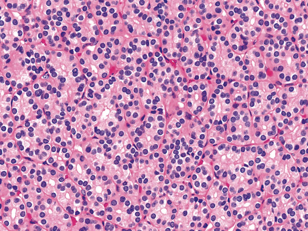 Thyroid Adenoma Histology 